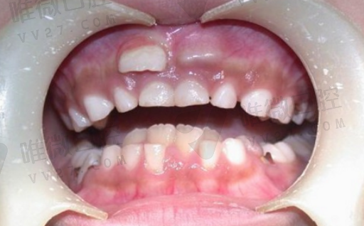 六龄齿窝沟封闭伤牙釉质吗,窝沟封闭实施方式方法(图1)